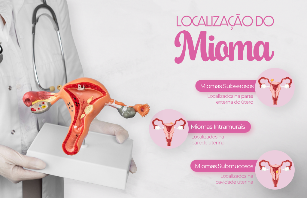 mioma uterino